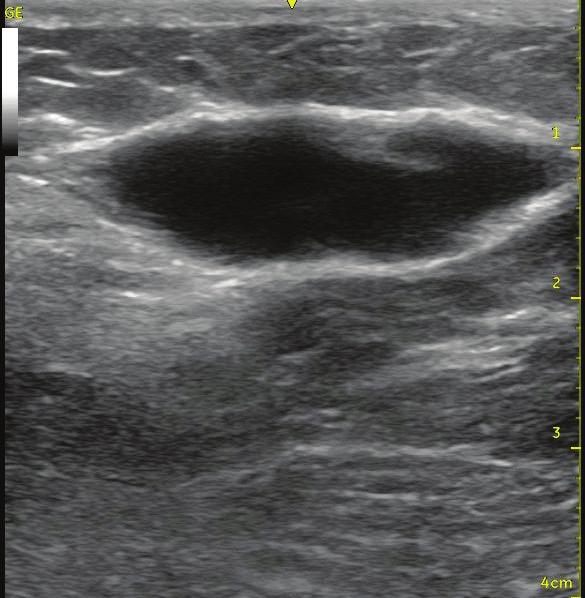 Some presentations of greater and lesser saphenous insufficiency that we believe benefit from an NTNT strategy include: Superficial or Epifascial Greater Saphenous Vein The position of the greater