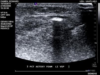 3. (ultrasound guided) foam sclerotherapy limited reports in literature: excellent immediate results (3 wks) in 45 legs with recurrent vv [Kakkos, J Endovasc Ther,