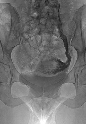 5. treatment of underlying pelvic vein incompetence in female