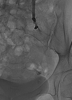 patients with pelvic vein incompetence had recurrent varicose