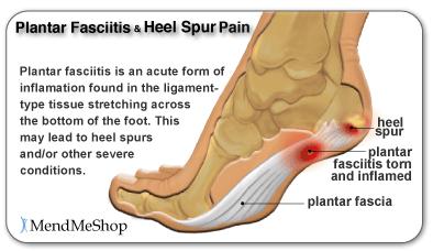 Clinical View: Plantar Fasciitis Inflammation of the plantar aponeurosis Associated with overexertion that stresses the fascia E.g.