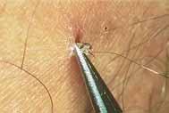 Proper Tick Removal 1. Use fine-point tweezers or tick removal tool 2. Grasp close to skin 3.