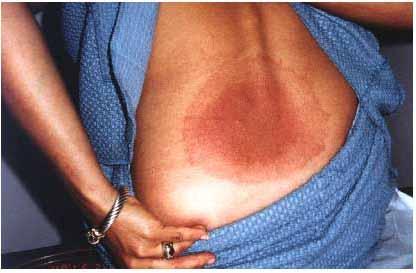 Lyme Rashes Large rash with