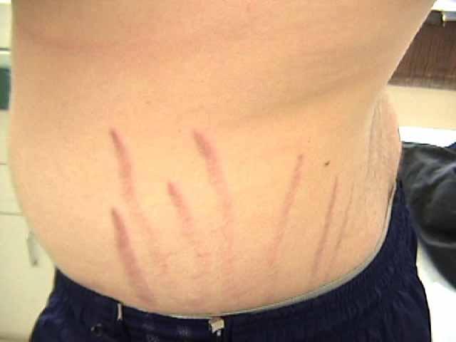 Co-Infection Bartonella Rashes Linear rashes look like stretch marks clinically associated