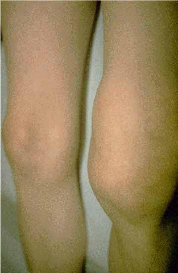 Joint Swelling Joint swelling and pain may occur weeks to months after onset