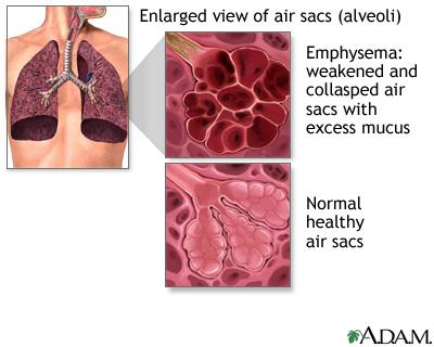 Asthma Pneumonia Acute pulmonary edema