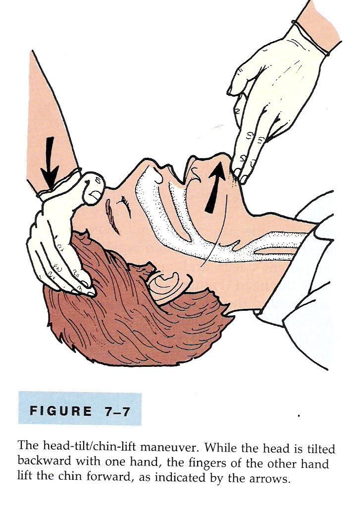 The head-tilt/chin-lift maneuver The rescuer s hand is placed on the patient s forehead and the head gently tilted back; the