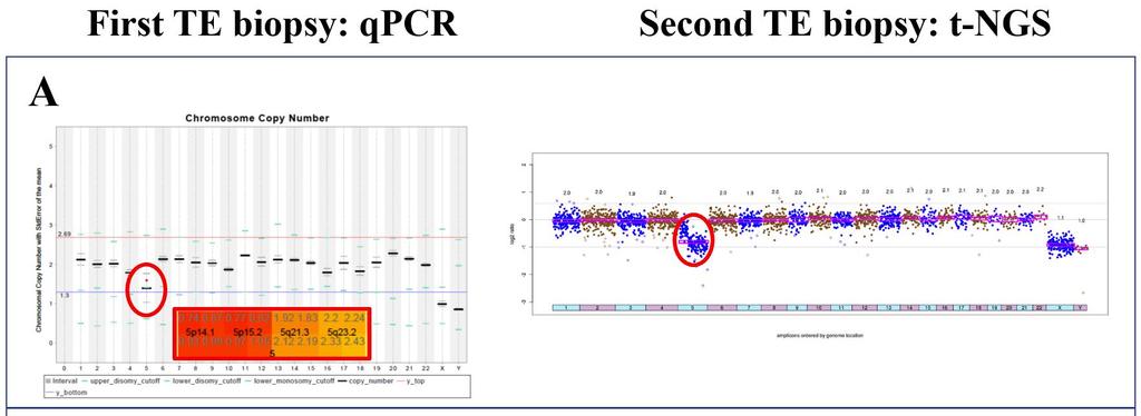Default qpcr detects large segmental aneuploidies in TE biopsies Chromosome CNVs Large de novo segmental aneuploidies (5/5) are