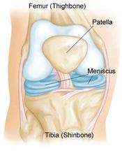 When people talk about torn cartilage in the knee, they are usually referring to a torn meniscus.