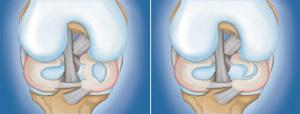 (Left) Bucket handle tear. (Right) Flap tear. (Left) Radial tear. (Right) Degenerative tear. Cause Sudden meniscus tears often happen during sports.