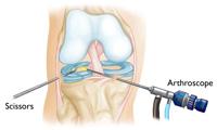 Knee arthroscopy A camera and instruments inserted through portals in a knee. Partial meniscectomy. In this procedure, the damaged meniscus tissue is trimmed away.