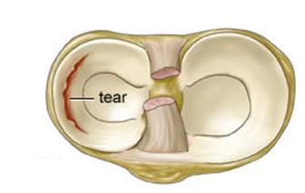 Another portion of the pain may be mechanical in nature, whereby the torn piece of meniscus or articular cartilage gets trapped in the joint and causes sharp episodes of pain, which can take a few
