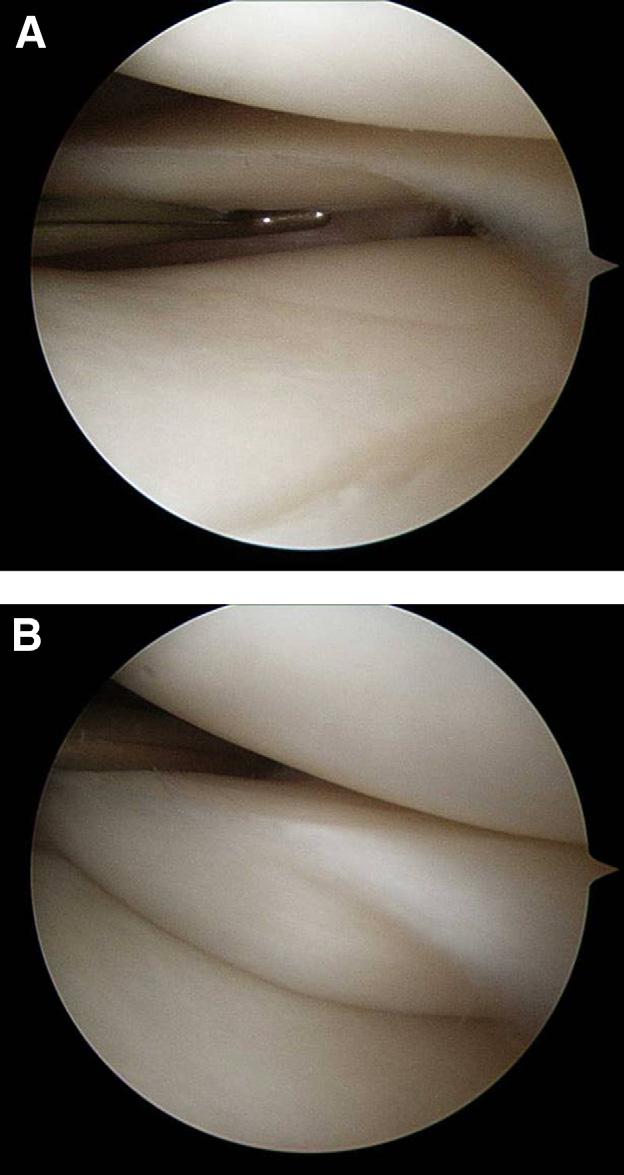 e102 H-K. SHIN ET AL. We postulated that popliteomeniscal fascicle tears would entail pain, locking, and giving way in the lateral compartment of the knee.