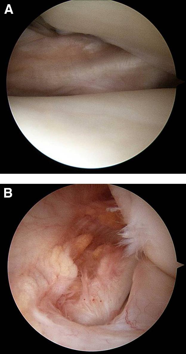 POPLITEOMENISCAL FASCICLE TEAR e103 easy repair, we did not use a zone-specific cannula.