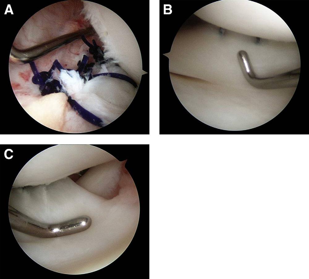 POPLITEOMENISCAL FASCICLE TEAR e105 FIGURE 5. Placement of additional 2 or 3 sutures. (A) Arthroscopic view (70 ) through the anteromedial portal of the knee posterior joint space.