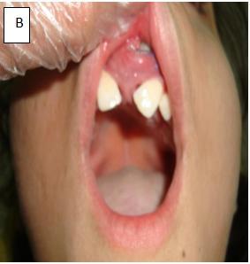 diffuse painless swelling over the premaxilla caused elevation of the frontal part of the face and the nose exposing a facial asymmetry (Figure 1- A).