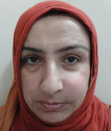 Case II A 35-year-old Kurdish female was referred to the Service of Maxillofacial Surgery at Sulaimani Teaching Hospital suffering from long term swelling of the left part of the face.