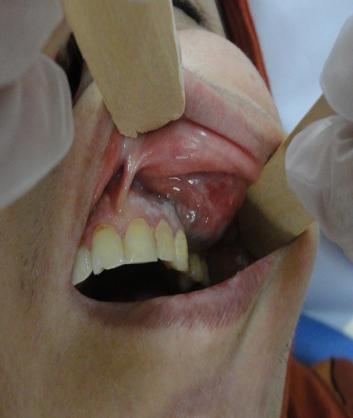 Intraoral examination showed a large swelling of the left maxilla at canine premolars and molars areas with buccal cortical plate expansion. Soft tissue overlying the lesion turned blush red in color.