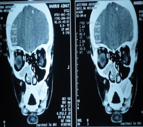 CT scan showed boney lesion affected left maxilla at the area of premolars and molars also other lesion was discovered in the right maxillary sinus (Figure 3-C).