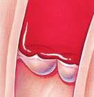Aortic semilunar: at the base of the aorta b.