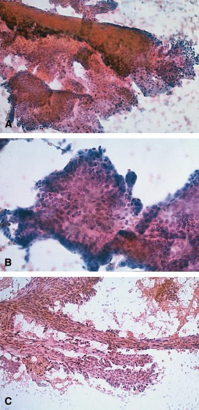 98 CANCER (CANCER CYTOPATHOLOGY) April 25, 2002 / Volume 96 / Number 2 FIGURE 3. Intraductal with atypia.