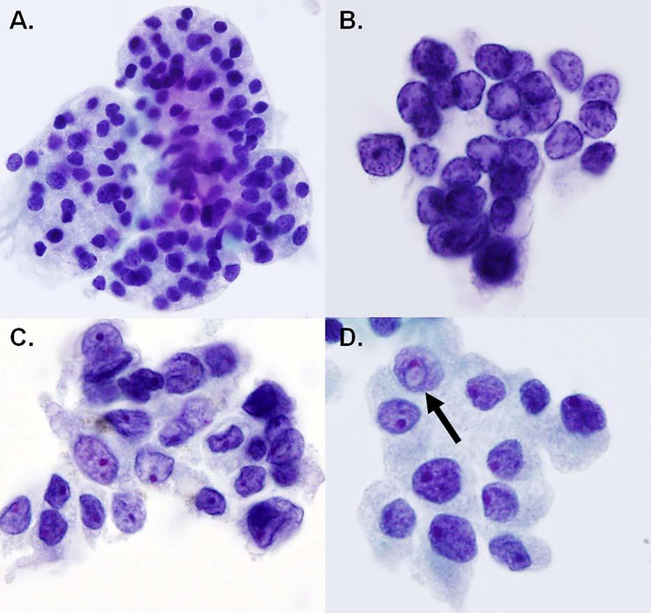 Review of Indeterminate FNAs and NIFTP/Strickland et al Figure 2. Cytologic features of benign nodules and noninvasive follicular thyroid neoplasm with papillary-like nuclear features (NIFTP).