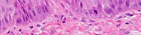 beyond cells of basal one third of the epithelium Formation of irregular tear