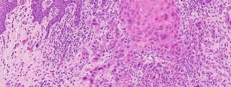 Hyperplasia-thickened epithelium due to increased number of cells>10 cells thick, may be associated with subjacent granular cell tumor Regeneration-proliferating epithelium with features of basal and
