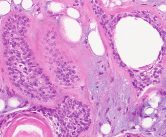 Although careful review of clinical history including prior history of malignancy may enable a correct diagnosis in few of these cases, additional excisional biopsy as performed in these cases may be