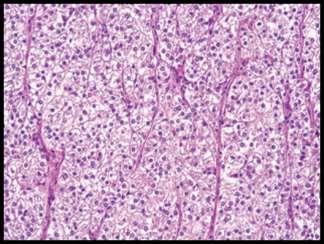 PEComa Epithelioid morphology Clear /eosinophilic cytoplasm Pink granular