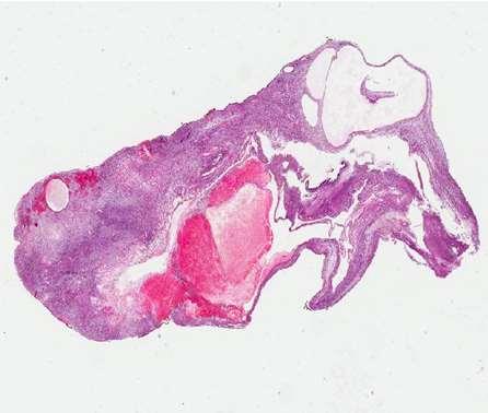 Endometrial stromal tumour Endometrial stromal