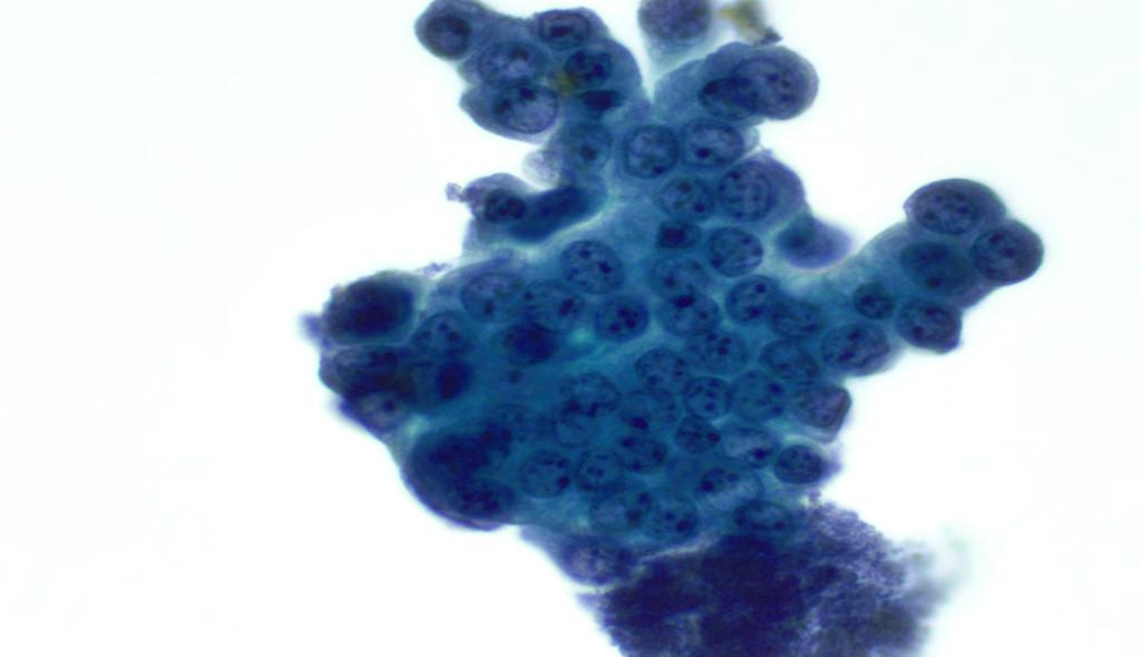 Interesting Case Presentation Atypia Nuclear enlargement Chromatin clumping Worrisome cytology However, Cells are arranged in flat sheets Smooth nuclear contours N/C ratio
