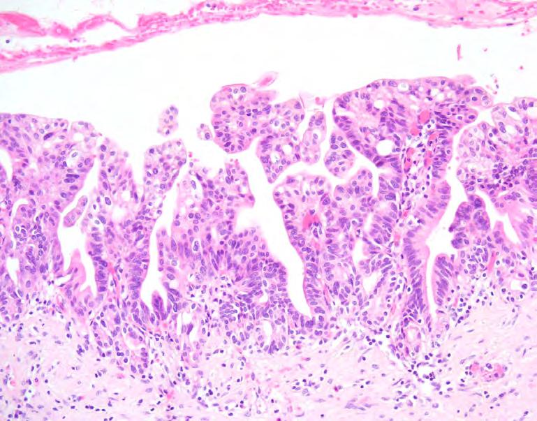 Biliary Intraepithelial Neoplasia (Dysplasia) Factors/context/etio-pathogenesis Established risk factors: Inflammation Dysplasia Parasites Carcinoma sequence It is sometimes difficult to