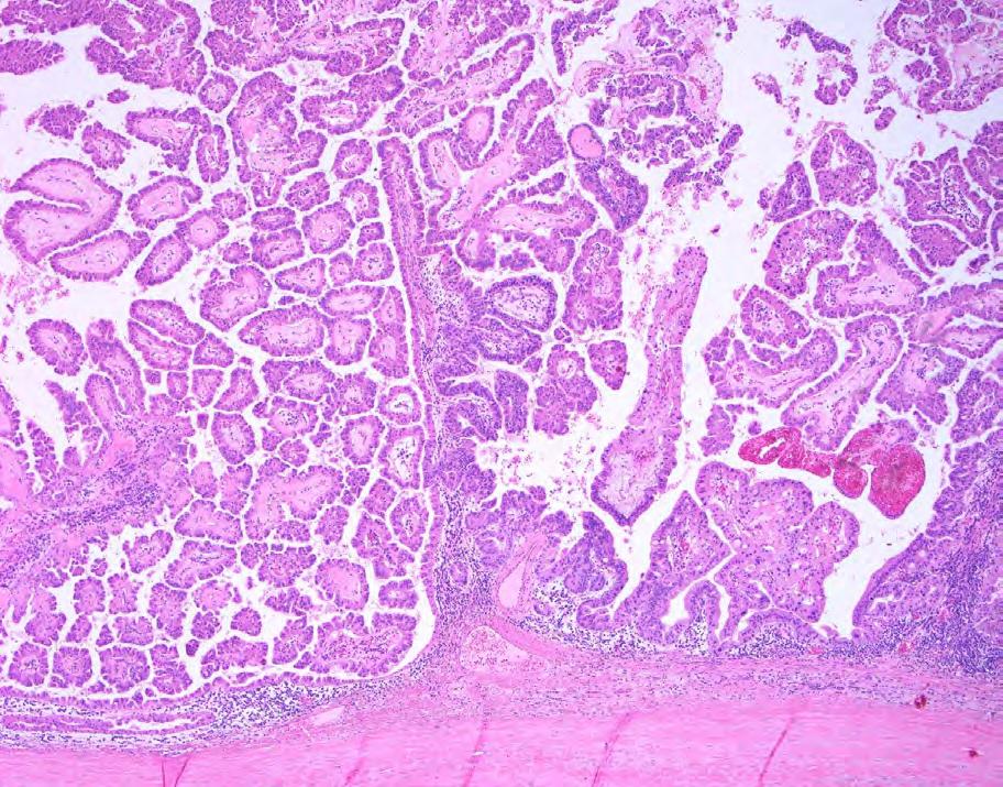 Tumoral IN of Biliary Tract (Mass-forming