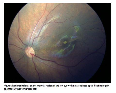 Clinical features in infants Eye abnormalities (microphthalmia, lens subluxation, cataracts, intraocular calcifications, optic n.