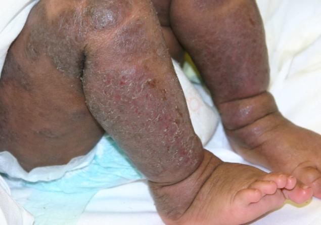 6/19/18 Atopic Dermatitis: A Chronic Inflammatory Disease M o s t c o m m o n fo rm o f e c z e m a A