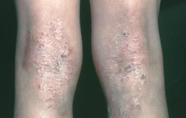 What Makes Atopic Dermatitis Worse?