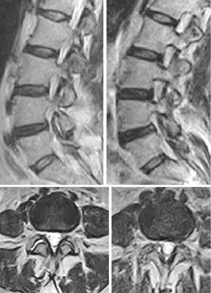 Slight accentuation of the protruding component in the upright position between L2 and L3 (arrows) and reduced discal height in the interspace between L3 and L4 (asterisks) is visible c d lumbar