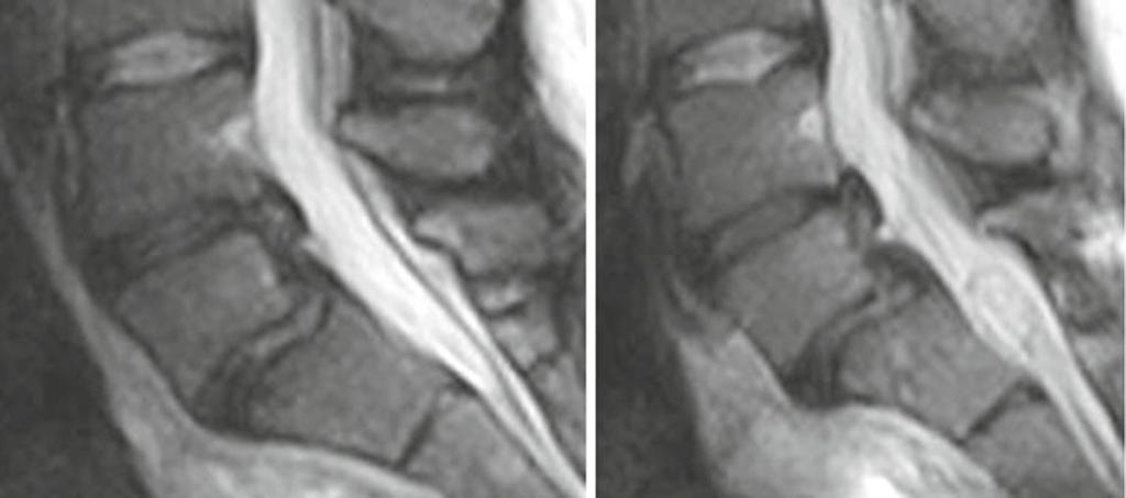J Orthopaed Traumatol (2013) 14:15 22 21 Fig. 10 Fast spin echo (FSE) T2-weighted magnetic resonance images (MRI) in the sagittal plane. a Clinostatism; b orthostasis.