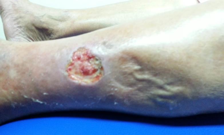 LEG ULCERS AND OEDEMA Oedema was present in 55% of patients, but its prevalence in the community-treated group was much greater than in the hospital-treated group.