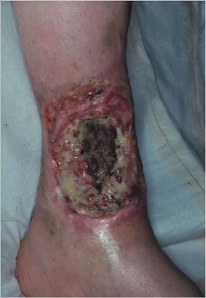 Differential diagnosis The most important differential diagnosis of leg ulcers are ulcerations caused by malignant or semimalignant diseases.