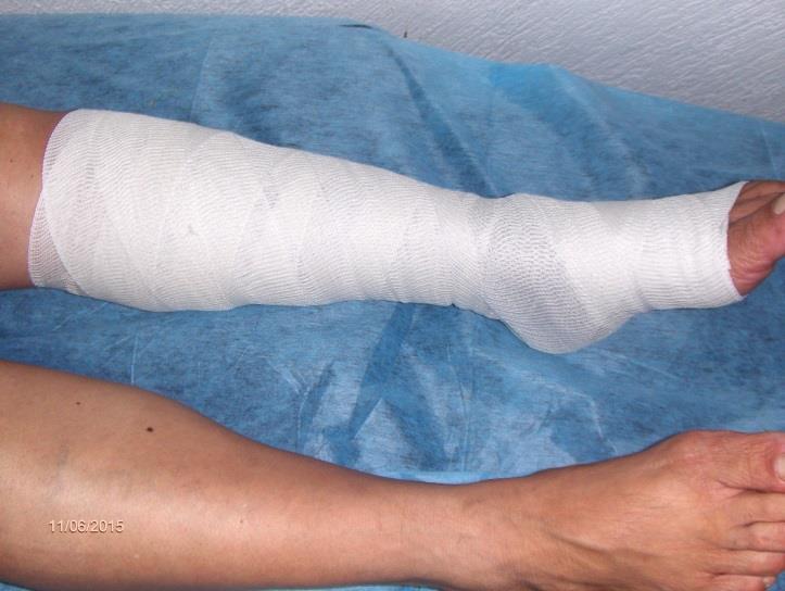 The most effective Tool Compression therapy is regarded as the basis of therapy in phlebology.
