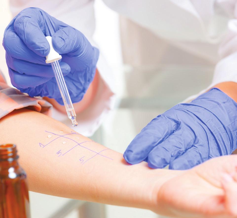 What is a skin prick allergy test? A skin prick allergy test is the most convenient and least expensive method to test for allergies.