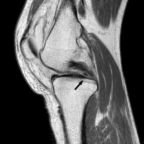 well as accompanying cartilage defects of the medial femoral condyle and pathologic medial meniscal extrusion.