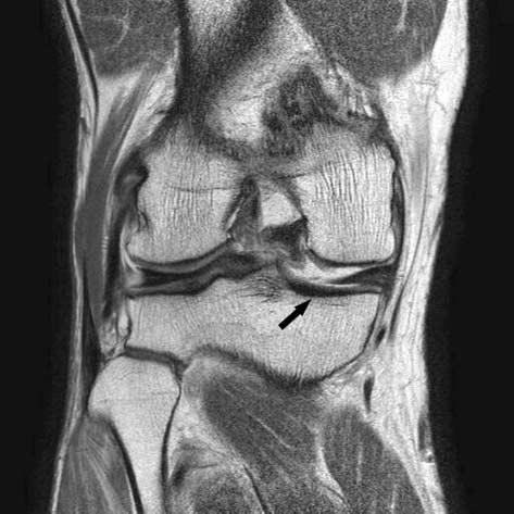 with exposure of subchondral bone. Results Arthroscopies performed on 146 knees revealed 48 medial meniscal posterior horn root tears (Table 1).