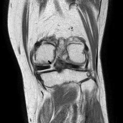 The incidence of degenerative joint disease in patients with root tears was 85% (41/48), revealing a strong association with root tear.