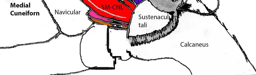 The SM-CNL band (red) of the Spring Ligment is the most important portion of the ligament.