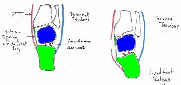 portion of the del- toid ligament and has a wide attachment to the SM-CNL.
