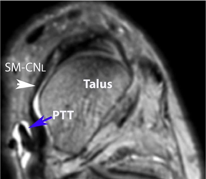 Axial Axial MR: SM-CNL band of the Spring Ligment is the strongest and most important portion of the ligament. This can be seen between the talar head/neck and the posterior tibial ten- don (PTT).