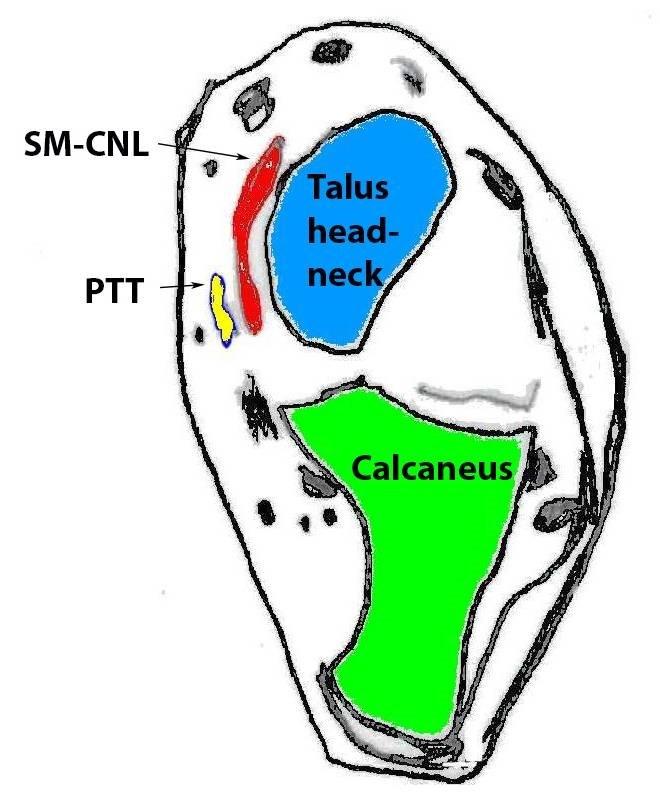 The best MR signs of clinically important spring liga- ment tears are increased signal on PD or T2 weighted images within the ligament with thickening of the ligament greater than 5 mm or thinning of